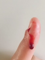 Photo of a finger that is bleeding