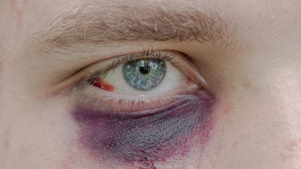 Photo of the light blue eye with a bruise under it.